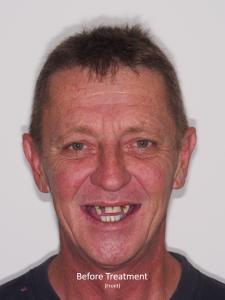 Before Treatment from the Front